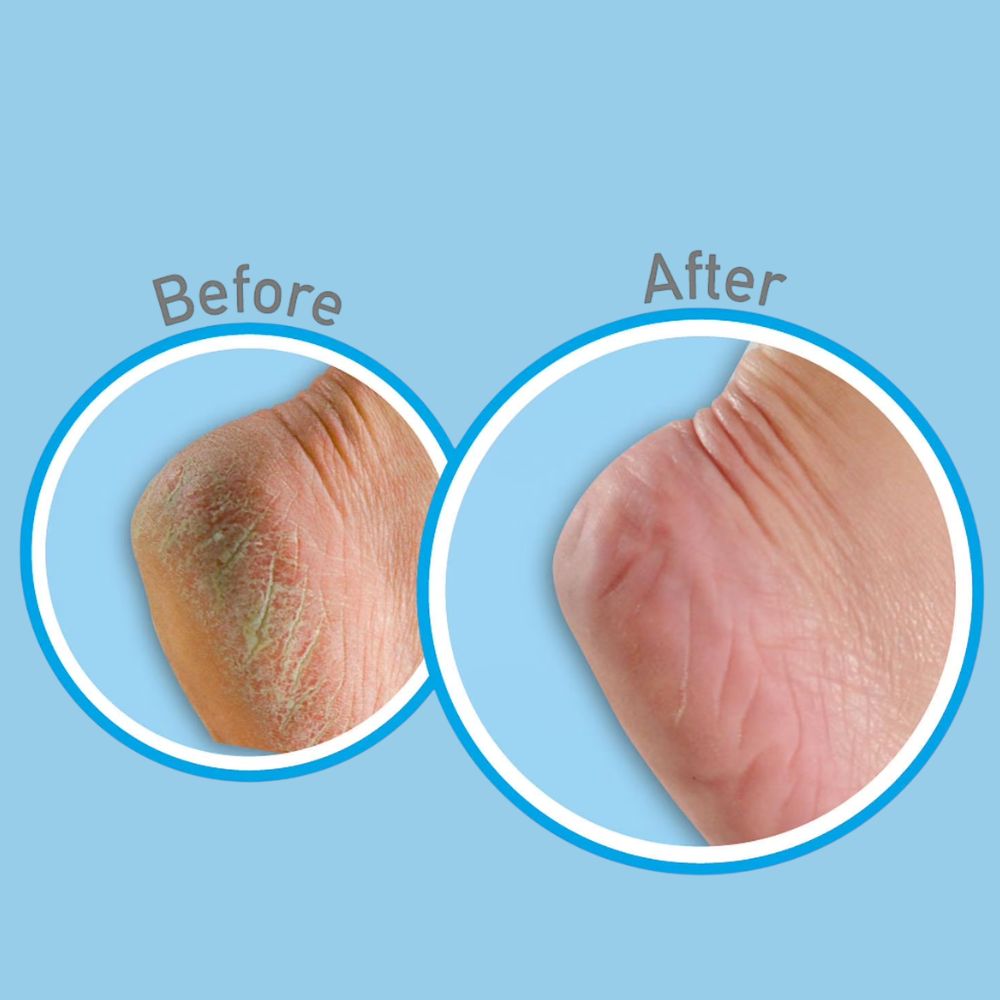 O’Keeffe’s for Healthy Feet Exfoliating Moisturizing Foot Cream – 85g