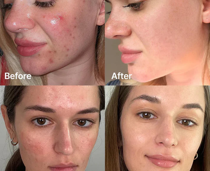 Medicube Red Serum with Succinic Acid for Acne Treatment – ​​30ml